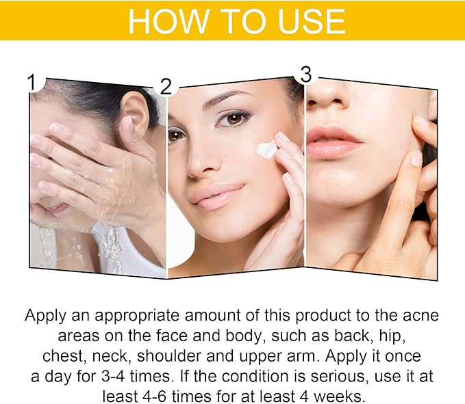 EELHOE Cystic Acne Cream – Targets Deep Breakouts & Clears Skin