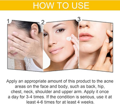 EELHOE Cystic Acne Cream – Targets Deep Breakouts & Clears Skin