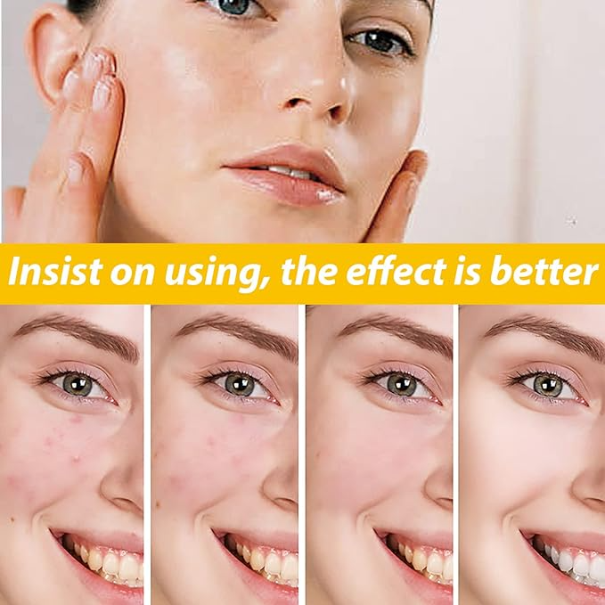 EELHOE Cystic Acne Cream – Targets Deep Breakouts & Clears Skin