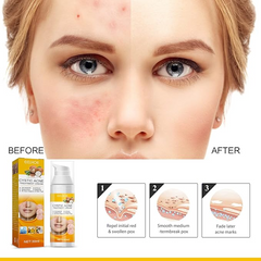 EELHOE Cystic Acne Cream – Targets Deep Breakouts & Clears Skin