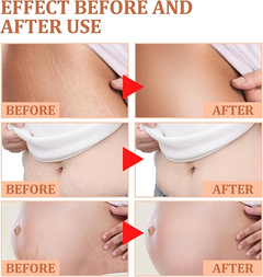 EELHOE Stretch Marks Removal Cream 45g – Fades Marks & Restores Smooth Skin