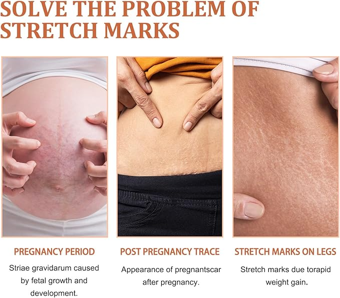 EELHOE Stretch Marks Removal Cream 45g – Fades Marks & Restores Smooth Skin