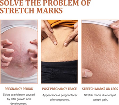 EELHOE Stretch Marks Removal Cream 45g – Fades Marks & Restores Smooth Skin